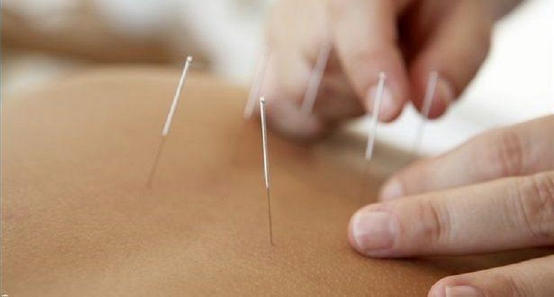 متخصص طب سوزنی اصفهان طب سوزنی برای لاغری شکم