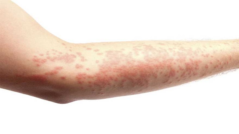متخصص طب سوزنی اصفهان