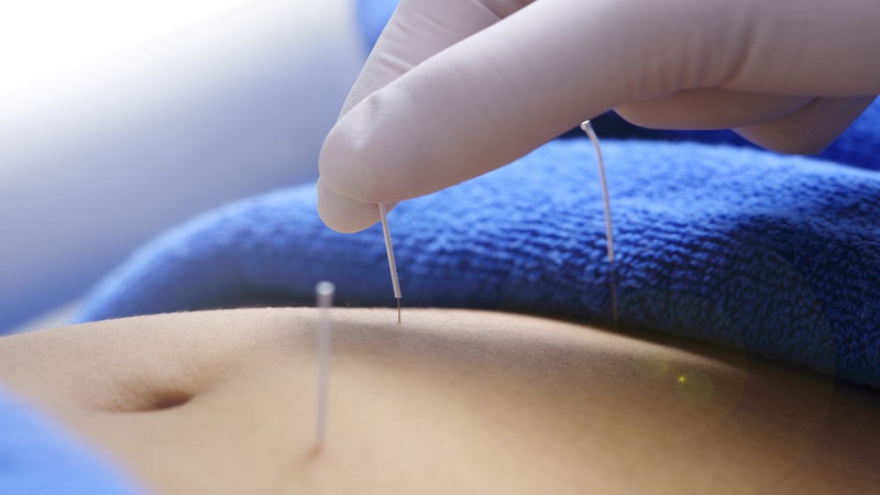 متخصص طب سوزنی اصفهان | درمان سندرم تخمدان پلی کیستیک با طب سوزنی چینی