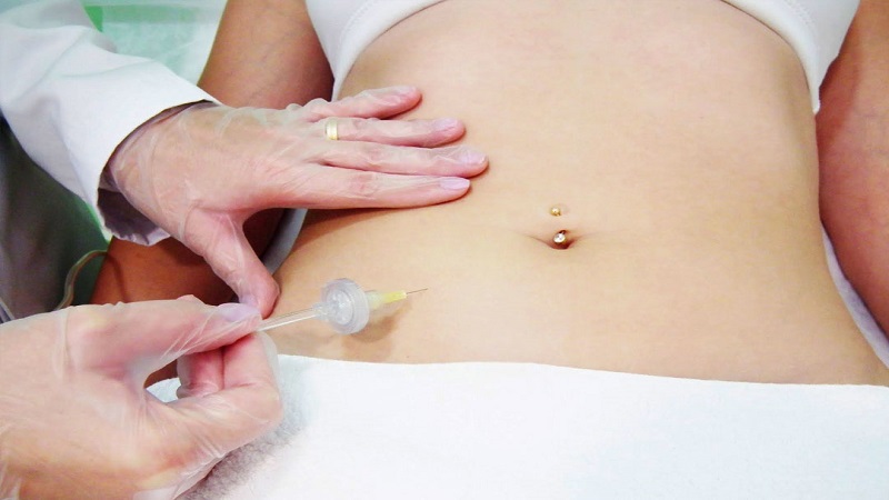 متخصص طب سوزنی اصفهان | کربوکسی تراپی سلولیت