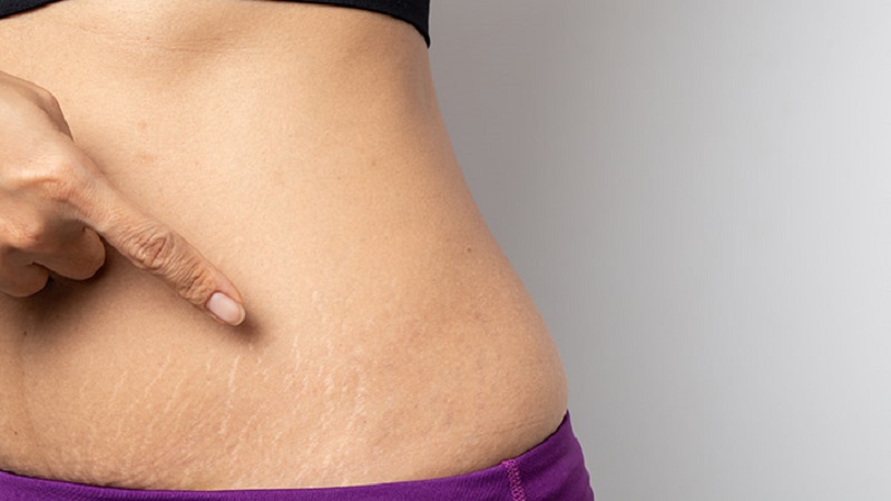 متخصص طب سوزنی اصفهان | استرچ مارک و دلایل بروز آن