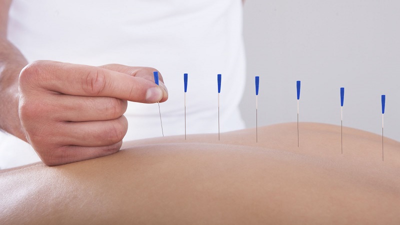 متخصص طب سوزنی اصفهان | طب سوزنی درمان درد گردن و نقاط فشار