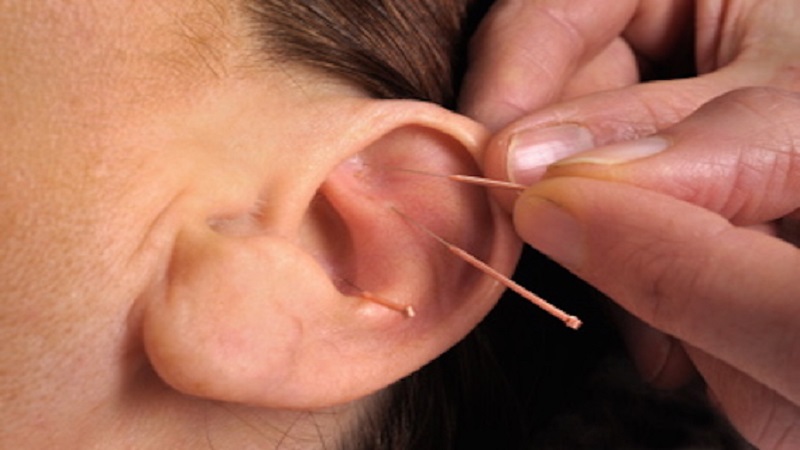 متخصص طب سوزنی اصفهان | آریکولوتراپی