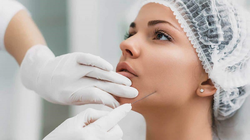 متخصص طب سوزنی اصفهان | جوانسازی پوست با لیفت صورت با نخ
