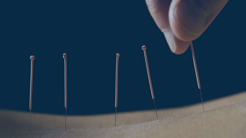 متخصص طب سوزنی اصفهان | طب سوزنی بر بیماری پارکینسون