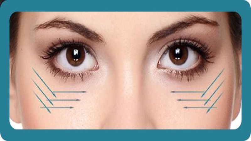 متخصص طب سوزنی اصفهان | لیفت نخ زیر چشم