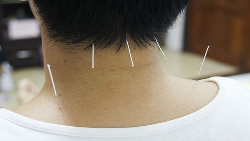 نقاط فشار برای تسکین درد گردن | متخصص طب سوزنی اصفهان
