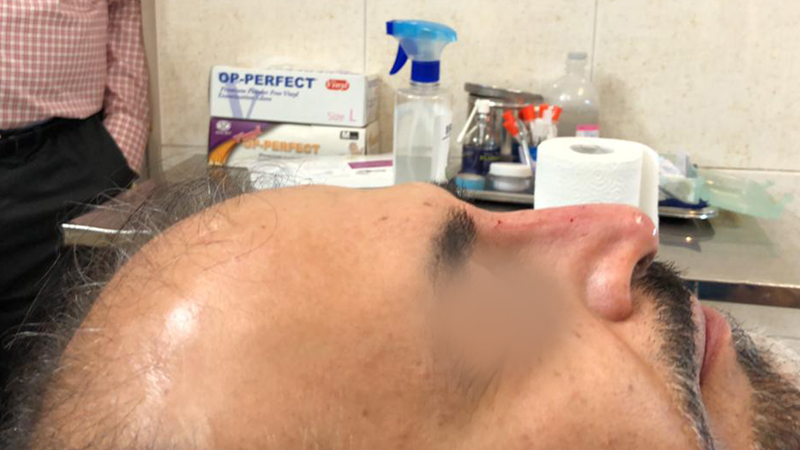 تزریق فیلر جهت اصلاح فرم بینی بدون نیاز به عمل جراحی | متخصص طب سوزنی اصفهان