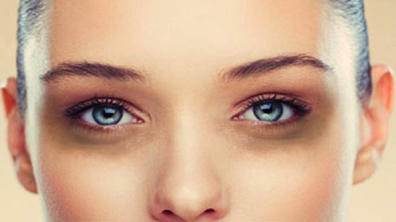 روش‌های کلینیکی برای درمان گودی زیر چشم | متخصص طب سوزنی اصفهان