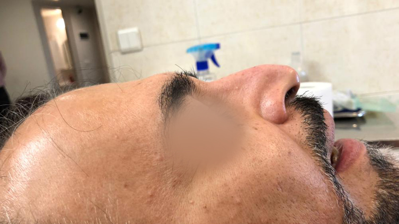 تزریق فیلر جهت اصلاح فرم بینی بدون نیاز به عمل جراحی | متخصص طب سوزنی اصفهان