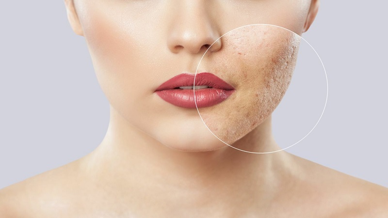 تعریف کلی منافذ باز پوست | متخصص طب سوزنی اصفهان