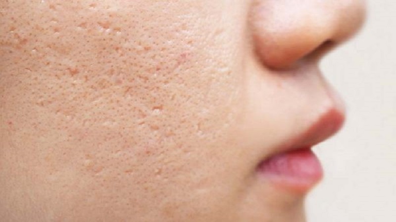 تعریف کلی منافذ باز پوست | متخصص طب سوزنی اصفهان