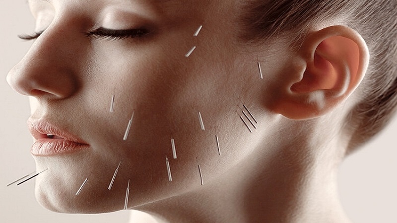 جوانسازی پوست با کمک طب سوزنی | متخصص طب سوزنی اصفهان