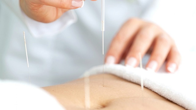 متخصص طب سوزنی اصفهان | تاثیر طب سوزنی در باروری
