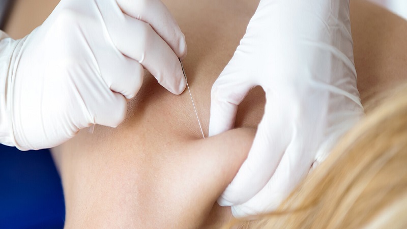 متخصص طب سوزنی اصفهان | تاثیر طب سوزنی در زندگی واقعی