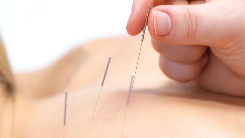 متخصص طب سوزنی اصفهان | تاثیر طب سوزنی
