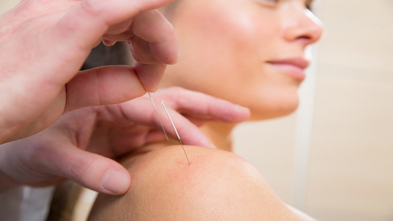 متخصص طب سوزنی اصفهان | تکنیک طب سوزنی و درمان شانه منجمد