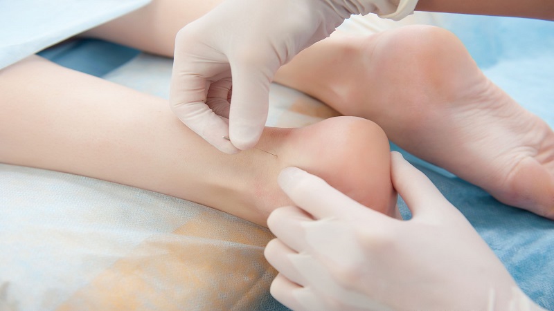 متخصص طب سوزنی اصفهان | درمان خارپاشنه با کمک طب سوزنی