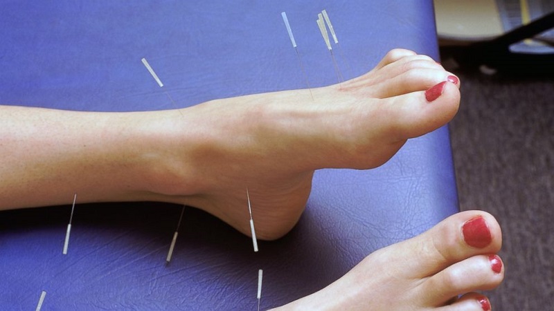 متخصص طب سوزنی اصفهان | طب سوزنی پا