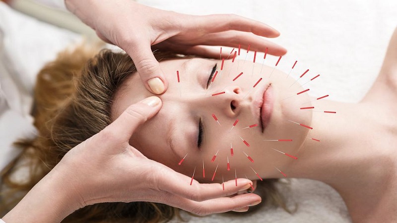 متخصص طب سوزنی اصفهان | طب سوزنی صورت