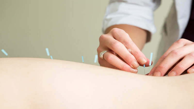 متخصص طب سوزنی اصفهان | مزیت طب سوزنی برای سلامتی