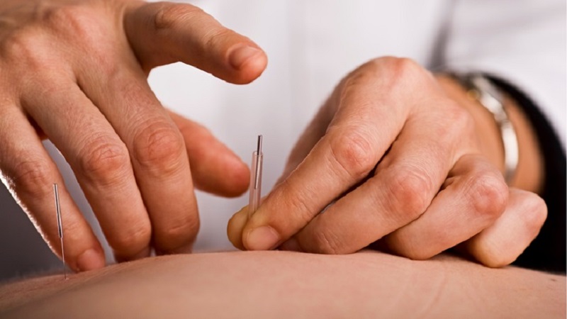 متخصص طب سوزنی اصفهان | تاثیر درمانی طب سوزنی بر سینوزیت.