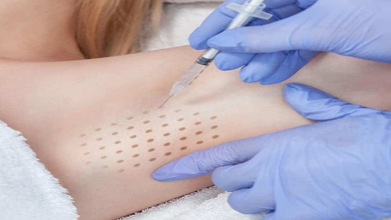 متخصص طب سوزنی اصفهان | درمان تعریق شدید زیر بغل با کمک تزریق بوتاکس