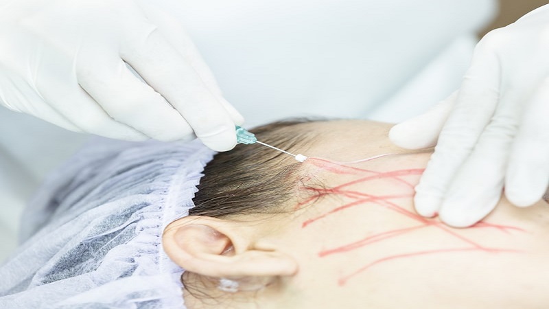 متخصص طب سوزنی اصفهان | نخ سیلوئت از چه چیزی ساخته شده اند؟