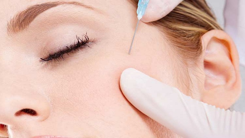 کاشت نخ لاغری اصفهان | کلینیک تزریق ژل.