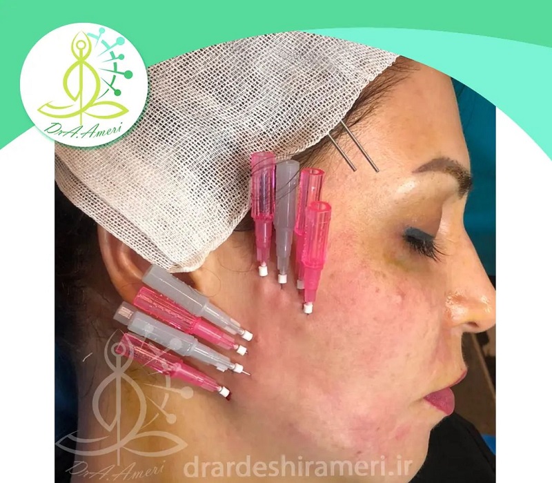 متخصص طب سوزنی اصفهان | زاویه سازی با کاشت نخ 