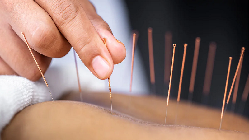 متخصص طب سوزنی اصفهان | درمان بیماری زنان با کمک طب سوزنی .