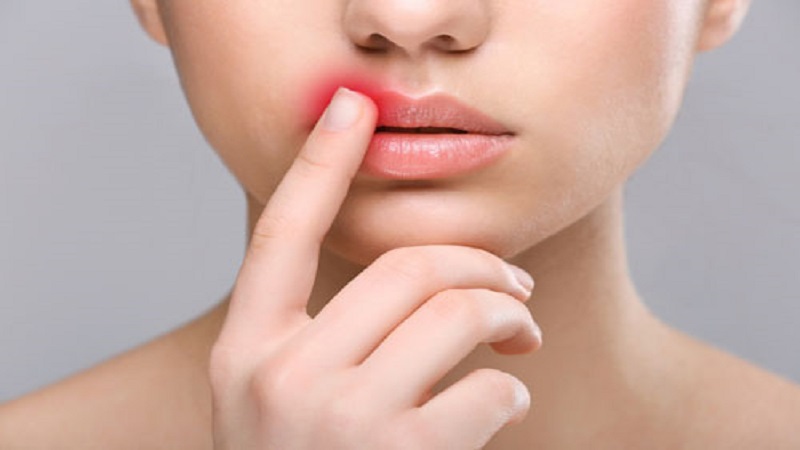 متخصص طب سوزنی اصفهان | تبخال بعد از تزریق ژل لب