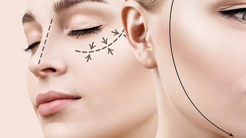 بهینه‌سازی لیفتینگ با ادغام امبدینگ و طب سوزنی | لیزر اندولیفت اصفهان | دکتر ادشیر عامری
