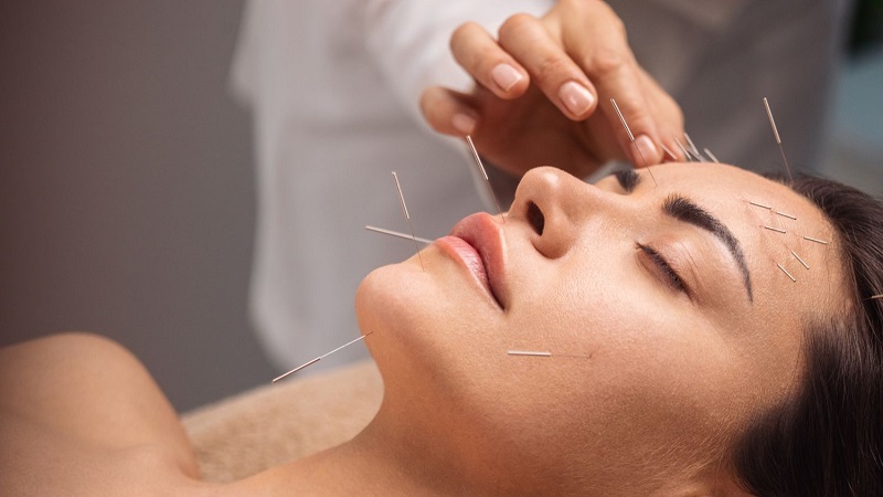 زیبایی طبیعی صورت با طب سوزنی | لیزر اندولیفت اصفهان | دکتر ادشیر عامری