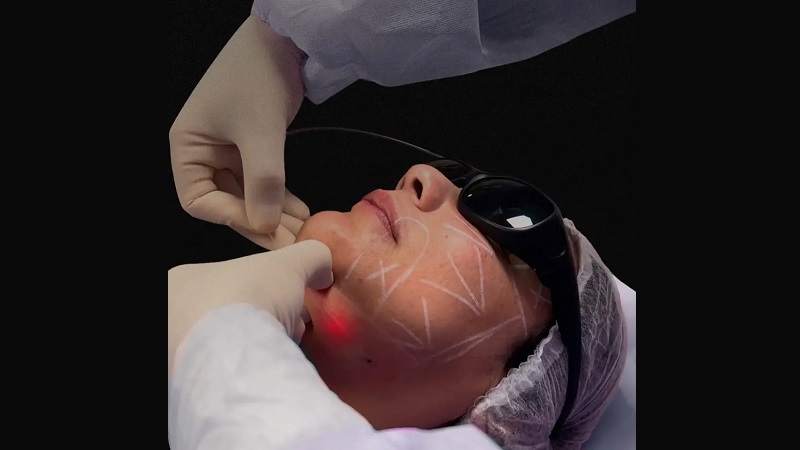 مقایسه لیفت با لیزر اندولیفت و لیزر CO₂ در فرم‌دهی و سفتی پوست | لیزر اندولیفت اصفهان | دکتر ادشیر عامری