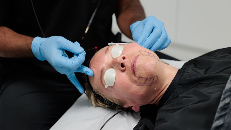 لیزر اندولیفت در بیماران مسن با پوست نازک | لیزر اندولیفت اصفهان | دکتر ادشیر عامری