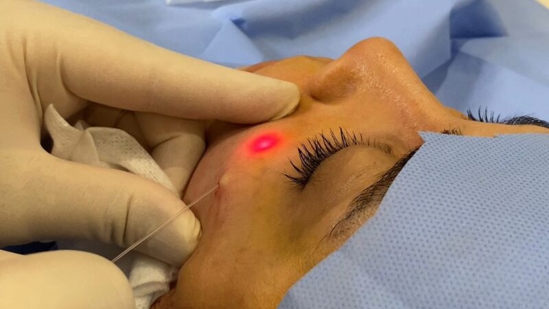 مدیریت عوارض نادر اندولیفت | لیزر اندولیفت اصفهان | دکتر ادشیر عامری