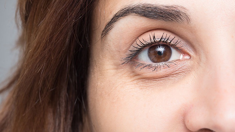 کاهش پف و تیرگی با اندولیفت زیرچشم | لیزر اندولیفت اصفهان | دکتر ادشیر عامری