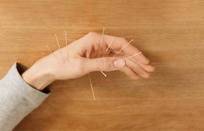 درمان لرزش دست با طب سوزنی؛ راهی طبیعی و غیرتهاجمی